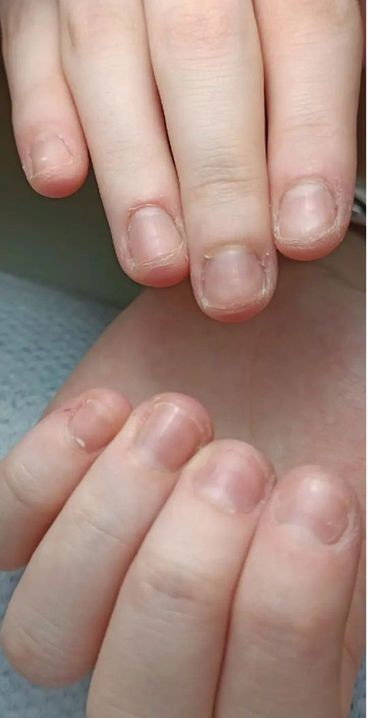 Unhas antes do procedimento